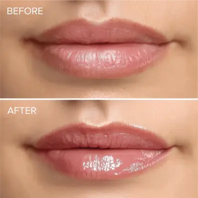 Before and After MAREE Amazon Lip