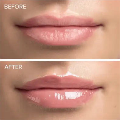Before and After MAREE Amazon Lip